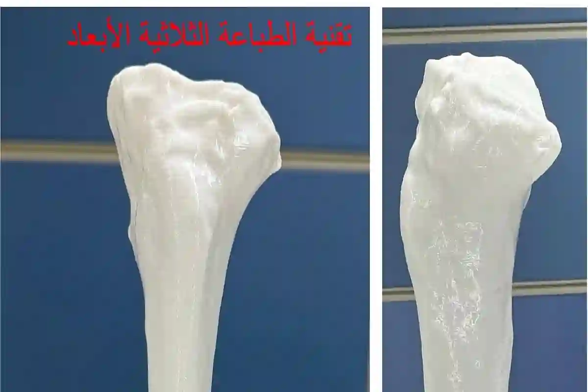 إنجاز طبي سعودي.. تصحيح انحراف الركبة بتقنية الطباعة ثلاثية الأبعاد